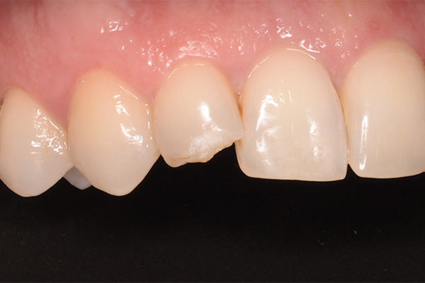broken tooth