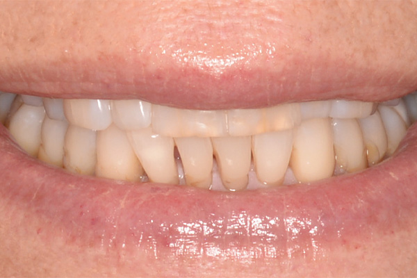 uneven, yellow teeth before veneers