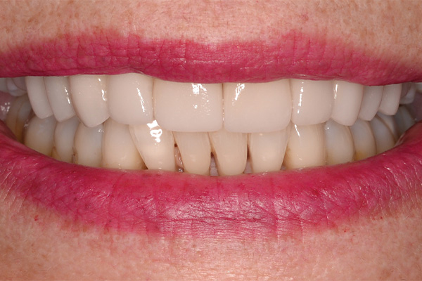 patient smile after veneers