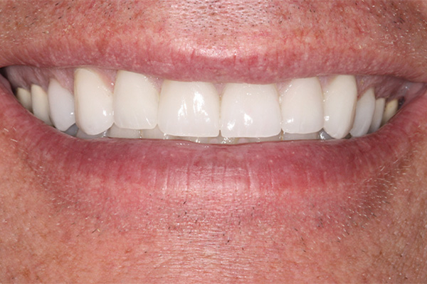 even upper front teeth after veneers