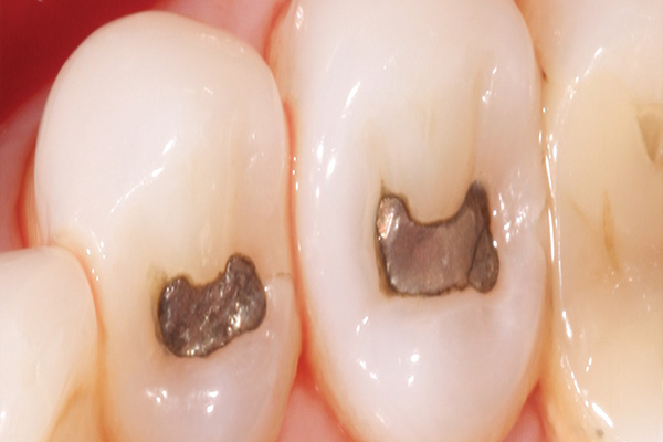 amalgam fillings before replacement with bonded fillings