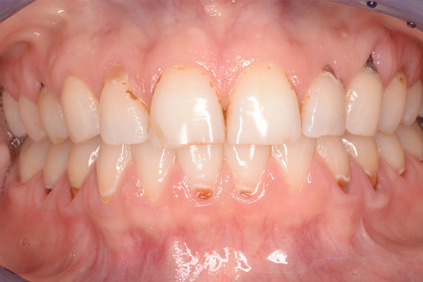 before dental bonded fillings