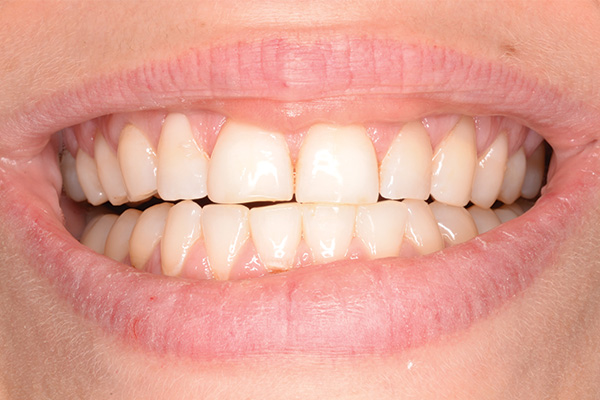 after dental bonded fillings